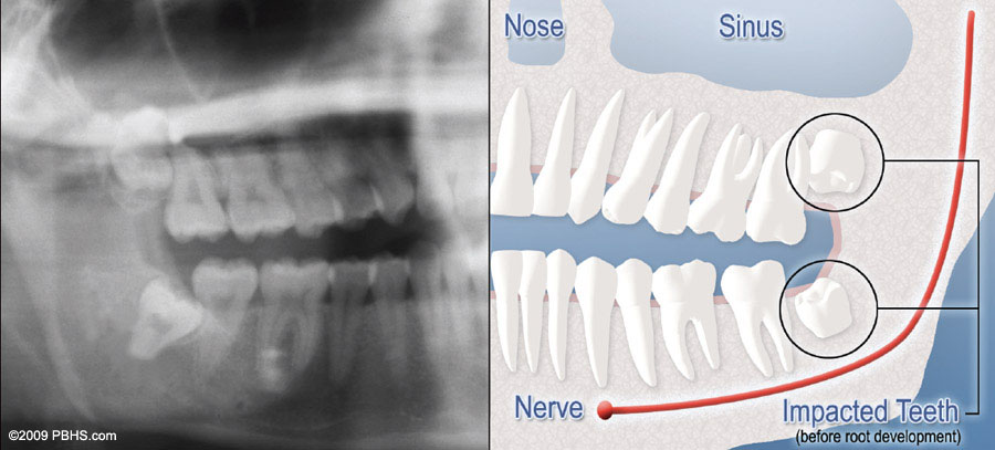 Top 10+ where are my wisdom teeth 1 Procedures - Wisdom Teeth - Stone Ridge Oral & Facial Surgery